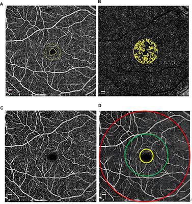 Inter-examiner and intra-examiner reliability of optical coherence tomography angiography in vascular density measurement of retinal and choriocapillaris plexuses in healthy children aged 6–15 years